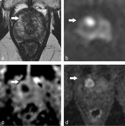 Multiparametric MRI performed in a 59-year-old patient presenting with dysuria and a family history of prostate cancer (a = T2-weighted image, b = diffusion-weighted image at 2,000 sec/mm2, c = apparent diffusion coefficient [ADC] map, d = dynamic image obtained after injection of gadolinium chelates). The rate of prostate-specific antigen was 2.2 ng/mL. Digital rectal examination found a nodule to the left. MRI showed a suspicious lesion with a score of PI-RADS 4 (arrow) in the anterior horn of the right apex. Systematic biopsies (12 samples) were negative. Biopsies targeting the MRI lesion showed prostate cancer with a Gleason score of 8 (4 + 4). Figure courtesy of Dr. Olivier Rouvière, PhD, republished from E-Quotidien des JFR.