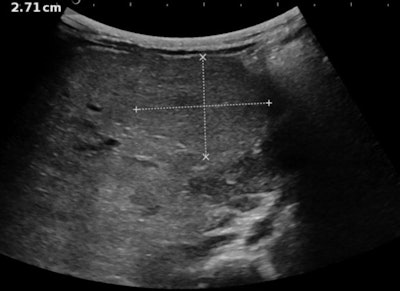 Multiparametric ultrasound exam in an 8-month-old baby referred for hepatoblastoma: Above: B-mode examination shows a heterogeneous liver with a well-circumscribed homogeneous tissular mass suspected in the initial center to be a nodule of hepatoblastoma. Below: Color-Doppler shows no specific vascularization of the mass. All images courtesy of Dr. Stéphanie Franchi-Abella.
