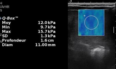 Same patient. Above: Elasticity of the mass is moderately increased (12 kPa). Second image: Elasticity of the liver parenchyma away from the mass is markedly increased (22.5 kPa). Last image: There is also a marked increase of spleen elasticity. In conclusion, the association of stiff liver and spleen is highly suggestive of chronic liver disease with a large regenerative nodule. This was confirmed by biology, which revealed tyrosinemia.