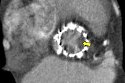 2018 10 29 23 28 0573 2018 10 30 Cardiac Imaging Ct Image Thumb