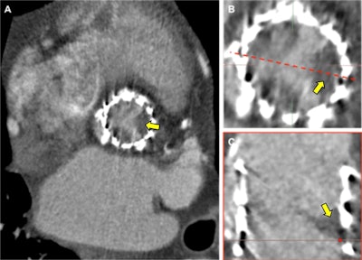 Transcatheter aortic valve replacement hypoattenuated leaflet thickening several months after transcatheter aortic valve implantation (26 mm Spaien 3, Edwards Lifesciences). Elevated transprosthesis pressure gradients were observed on echocardiography, and 4D cardiac CT was performed (A). Hypoattenuation of all three prosthesis cusps was present with a restricted excursion of the leaflets during ventricular systole (B). Laminar deposition of low attenuation material on the aortic aspect of the prosthesis results in the thickened appearance of the leaflet (C). Resolution with anticoagulation and restoration of normal leaflet motion is observed with this CT finding suggesting it may represent subacute thrombus. All images courtesy of BIR.