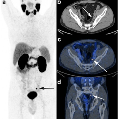 A 65-year-old patient with radical prostatectomy and pelvic lymph node dissection for prostate cancer (GS 4 + 3, pT3bN0Mx), adjuvant radiation therapy, and targeted pelvic lymph node dissection, biochemical recurrence after five years (prostate-specific antigen 0.3 ng/mL).As cause for biochemical recurrence (prostate-specific antigen 0.45 ng/mL), a single iliac lymph node metastasis was detected using GA-68 PSMA PET/CT. Images courtesy of Prof. Clemens Cyran.