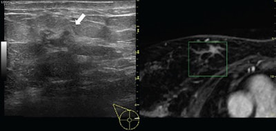 Ultrasound image (left) with the corresponding multiplanar reconstructed MR image (right) of a 54-year-old woman with a suspicious lesion at the upper-internal quadrant of the right breast. MR imaging showed an irregular branched enhancing lesion of 23 mm, undetected at second-look ultrasound. Second-look ultrasound with volume navigation showed the corresponding area (white arrow). Pathology obtained with ultrasound-guided biopsy with volume navigation demonstrated an invasive ductal carcinoma with an extensive intraductal component (green box). All images courtesy of Dr. Alfonso Fausto.