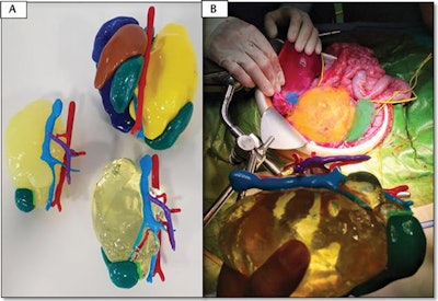3D-printed models of an abdominal neuroblastoma (yellow) with surrounding organs and vasculature: aorta (red), liver (dark blue), kidneys (green), spleen (brown). Image courtesy of Dr. Ángela Sánchez-Sánchez et al, 'Three-Dimensional Printed Model and Virtual Reconstruction: An Extra Tool for Pediatric Solid Tumors Surgery,' European Journal of Pediatric Surgery Reports (2018, Vol. 6:1, pp. e70-e76). Shared via Creative Commons license.