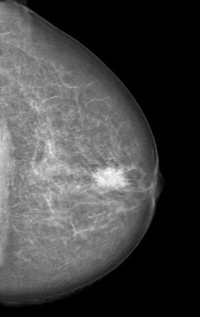 Mammogram manipulated with a neural network-generated mass. Image courtesy of RSNA and Dr. Anton Becker.