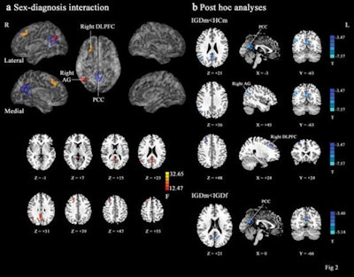 A: Images show brain regions with sex (male, female) and diagnosis (IGD, healthy control) interactions in functional connectivity (FC). B: Male participants with IGD showed lower FC values between the orbital part of the left superior frontal gyrus and the posterior cingulate cortex, the right angular gyrus, and the right dorsolateral prefrontal cortex than male healthy controls. Male participants with IGD also exhibited lower FC values between the orbital part of the left superior frontal gyrus and the posterior cingulate cortex than female participants with IGD. Image courtesy of Dr. Yawen Sun and RSNA.