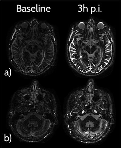 Example of contrast enhancement three hours postinjection (3h p.i.) of a single dose of a gadolinium-based contrast agent on heavily T2-weighted fluid-attenuated inversion-recovery (FLAIR) imaging, compared with precontrast baseline in a 77-year-old man without any neurological disorder and normal renal function. a: Axial heavily T2-weighted FLAIR image on the level of the anterior eye segment at three hours postinjection demonstrates distinctive enhancement of the aqueous and vitreous chamber of the eyes, the distal optical nerve sheath, the choroid plexus, and the subarachnoid space compared with the precontrast baseline scan. b: Contrast enhancement of the prepontine cistern, fourth ventricle, subarachnoid space, cochlea, and Meckel's cave can be observed at three hours postinjection compared with the native baseline scan. Image courtesy of Dr. Alexander Radbruch, JD.