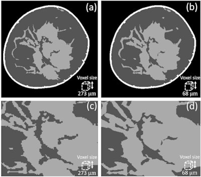 Example of an original, segmented breast CT slice from a patient case (a) and the corresponding slice of the generated superresolution phantom (b). Panels c and d show a magnification of the same region of both slices.