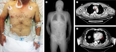 (A) Hemorrhagic lesions evenly distributed across the torso and arms. (B) Whole-body CT scan shows the pellets. Cross-sectional CT scans show one pellet close to the floor of the aortic arch (C) and one between the pericardium and the lateral wall of the left ventricle (D). Reprinted from the Lancet, https://doi.org/10.1016/S0140-6736(18)33001-0, Clerici et al, A lucky escape during a hunting accident, Copyright (2018), with permission from Elsevier.