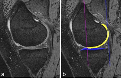 Cartilage quantification based on 3D MRI. A: Sagittal dual-echo at steady-state (DESS) MRI is commonly used for cartilage segmentation. Cartilage appears as a bright signal band between the subchondral bone and the intraarticular cavity. B: The femoral segmentation is color-coded in yellow and the tibial boundaries of cartilage are coded in blue. In addition, the subregional demarcations are shown (purple and blue lines). Image courtesy of Drs. Wolfgang Wirth and Felix Eckstein, Paracelsus Medical University in Salzburg, Austria, and the BJR.