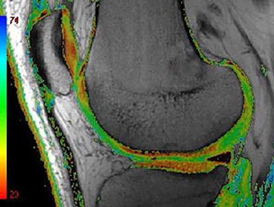 Compositional MRI can depict intratissue structural alterations that are not visible to the human eye. Color-coded T2 map MRI shows areas of focal increase in T2 times as green areas. T2 relaxometry is the most commonly applied compositional technique because it is available on most clinical MRI platforms. Image courtesy of Dr. Daichi Hayashi et al and BJR.