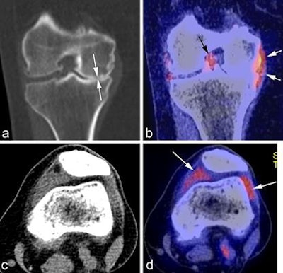 A: Coronal CT reformatted image shows marked medial joint space narrowing reflecting advanced osteoarthritis (white arrows). B: Corresponding fused PET image shows glucose accumulation around the medial meniscus reflecting focal synovitis (white arrows). Another focus of synovitis is shown around the posterior cruciate ligament in the intercondylar notch (black arrow). C: Axial CT image in soft-tissue kernel shows distension of the joint capsule, but is not able to differentiate between fluid and synovitis. D: Matched axial PET image shows marked glucose uptake in the medial and lateral peripatellar regions reflecting hypermetabolic active synovitis (arrows). Image courtesy of Dr. Daichi Hayashi et al and BJR.