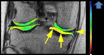 Compositional MRI has become increasingly important for evaluation of the early stage of osteoarthritis before morphological changes that can be depicted on conventional MRI occur, and dGEMRIC is one such technique. In this patient with knee pain, the coronal T1 gadolinium map shows degenerative a horizontal tear of the medial meniscus posterior horn (arrowhead) with low dGEMRIC index (suggesting the presence of compositional abnormality) in otherwise morphologically normal medial tibial plateau cartilage (arrows). Image courtesy of Dr. Daichi Hayashi.