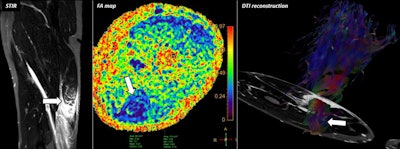 A 50-year-old male with acute pain at the posterior aspect of the thigh during a football match. MRI shows severe semitendinosus tear (grade III) at morphological study (arrow). DTI reveals a severe decrease of fractional anisotropy (FA) values at injury site (arrow). Note the twist-shape appearance of hamstrings on DTI reconstruction with retraction of muscle fibers (arrows). All images courtesy of Dr. Teodoro Martín Noguerol.