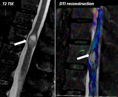 A 65-year-old female with cauda equina syndrome. A cystic lesion is identified at the lower spinal cord. The marked decrease of fractional anisotropy values within the cystic component of ependymoma (arrow) leads to an absence of representation of fibers/white-matter tracts at this level. Note the thinning and displacement of the rest of tracts around the lesion. DTI has the added value for surgical planning and assessing the behavior of spinal cord tracts, which are displaced by the lesion.