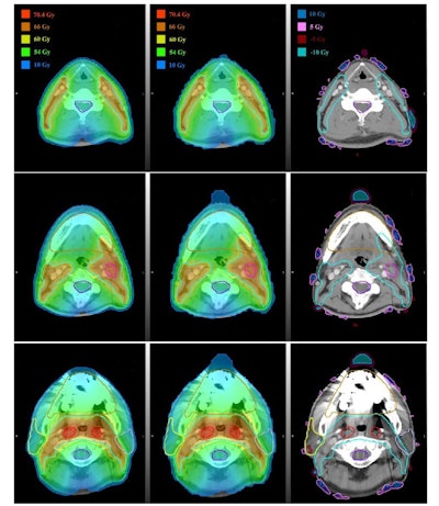Dose distributions for a head and neck cancer patient. Left column: predicted plan; center: automatic generated plan; right: voxel-by-voxel difference maps. Images courtesy of Medical Physics (10.1002/mp.13271).