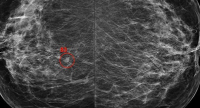 The Transpara software assists radiologists with reading screening mammograms. Image courtesy of ScreenPoint.