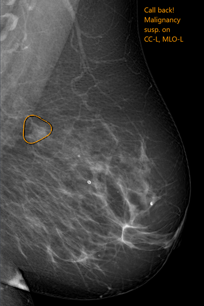 2019 01 15 20 17 5633 Kheiron Technologies Mammogram 20190115210205