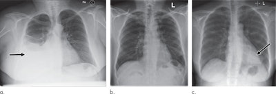 Examples of radiographs that were correctly and incorrectly prioritized by the AI system. A: Radiograph was reported as showing large right pleural effusion (arrow). This was correctly prioritized as urgent. B: Radiograph was reported as showing 'lucency at the left apex suspicious for pneumothorax.' This was prioritized by the AI system as normal. On review by three independent radiologists, the radiograph was unanimously considered to be normal. C: Radiograph was reported as showing consolidation projected behind the heart (arrow). The finding was missed by the AI system, and the study was incorrectly prioritized as normal. All images courtesy of Radiology.