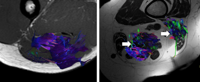 3D reconstructions of muscle fibers of hamstring muscles from diffusion-tensor imaging in a health volunteer (left image) and elderly patient (right image). Note the loss of muscle fiber density in the elderly patient (arrows). All images courtesy of Drs. Mercedes Vallejo Márquez and Teodoro MartĂn Noguerol.