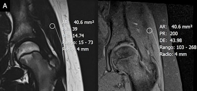 The fat fraction -- measured by a region of interest on the coronal fat- and water-only images from T1-weighted turbo spin-echo Dixon scan of the gluteus medius muscle -- was 16.3% in a healthy 11-year-old patient (A, above) and 36.7% in a 65-year-old patient (B, below).
