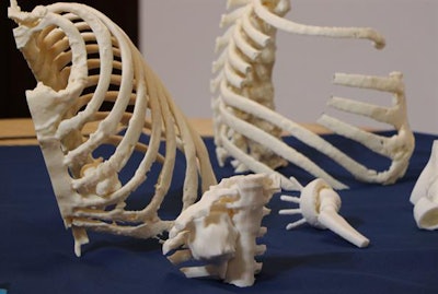 3D-printed thoracic wall and tumors used as a surgical guide. Image courtesy of Stratasys.