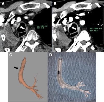 Conventional CT scan (A), DECT scan (B), 3D volume-rendered DECT scan (C), and 3D-printed model of the bronchial tree (D). The virtual monoenergetic image of the DECT scan enhances visualization of the tracheal malignancy (white arrow). Image courtesy of Kikano et al. Shared via Creative Commons license.