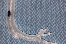 2019 01 31 03 22 8685 2019 01 31 3 D Printed Trachea 20190131035030