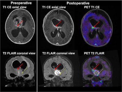 Axial (top) and coronal views (bottom) from 3-year-old boy with a grade IV atypical teratoid/rhabdoid tumor. A large intraventricular contrast-enhancing tumor mass (left column) was discovered preoperatively. Postoperative MRI identified a contrast-enhancing residual tumor inferiorly in the resection cavity (thin yellow arrow). An additional small residual tumor (red arrow) was identified only by FET-PET. Complete resection was obtained by removing both residual tumor masses. The patient received radiochemotherapy and is in long-term remission. Images courtesy of JNM.