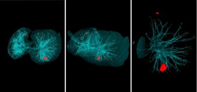 The AI software can flag lung nodules on CT scans within 20 seconds. Image courtesy of Peter the Great St. Petersburg Polytechnic University.