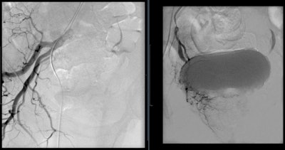 Angiogram of the right internal iliac artery showing the origin of the right prostatic artery and then very selective catheterization of the right prostatic artery by microcatheter.