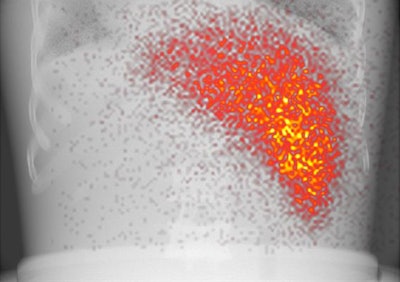A hybrid image of an anatomical phantom. Activity in the liver is projected on the x-ray background image. Image courtesy of Sandra van der Velden et al.