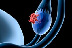2019 02 14 23 39 7184 Ovary Cancer 400