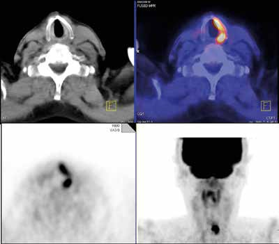 This clinical case shows a potential false-positive interpretation. A 70-year-old man with thyroid cancer and multiple past surgeries underwent restaging because of rising tumor marker. FDG-PET/CT showed asymmetric strong FDG uptake in the left vocal cord due to right recurrent laryngeal nerve palsy from prior surgery and tumor involvement. The compensatory activation of the nonparalyzed left vocal cord showing increased FDG uptake should not be misinterpreted as malignancy. Image courtesy of Dr. Christina Pfannenberg.