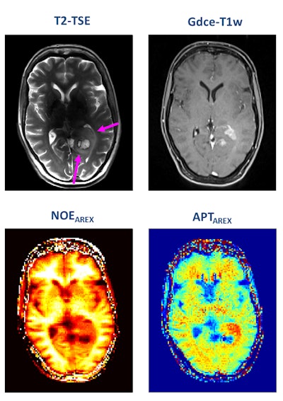 A patient with newly diagnosed glioblastoma underwent relaxation-compensated chemical exchange saturation transfer (CEST) imaging at 7.0 tesla. The protein-weighted CEST contrasts by means of amide proton transfer (APT) and nuclear Overhauser effect (NOE). MRI shows distinct alterations of protein concentrations in the tumor area. While APT signals are markedly increased, NOE-mediated CEST effects drop in the tumor area. The endogenous CEST contrasts have recently proven high potential as novel MR biomarkers to noninvasively assess tumor characteristics and prognosis. (See: Paech D, Windschuh J, Oberhollenzer J, et al, Assessing the predictability of IDH mutation and MGMT methylation status in glioma patients using relaxation-compensated multi-pool CEST MRI at 7.0 T, Neuro-Oncology, November 2018, Vol. 20:12, pp. 1661-1671, and Regnery S, Adeberg S, Dreher C, et al, Chemical exchange saturation transfer MRI serves as predictor of early progression in glioblastoma patients, Oncotarget, June 2018, Vol. 9:47, pp. 28772-28783.) Image courtesy of Dr. Heinz-Peter Schlemmer.