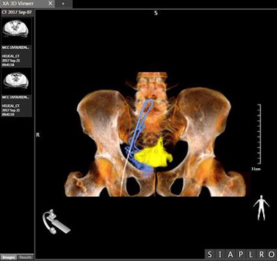 Image of prostate cancer embolization acquired with Canon's Alphenix interventional system in 4DCT mode. Image courtesy of Canon Medical Systems.