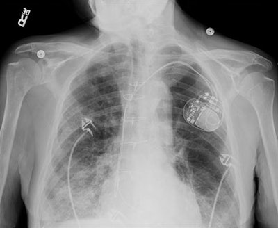 Adult chest with pacemaker imaged using the Helix advanced processing tool. Image courtesy of GE Healthcare.