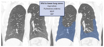 Pathologies with GGO in a mid to lower distribution. The image is taken from a case of nonspecific interstitial pneumonia (NSIP). One of the most important locations to look at in a lower distribution of chronic GGO is the costophrenic angle, which may be involved (NSIP, desquamative interstitial pneumonia [DIP]) or spared (hypersensitivity pneumonitis [HP]).