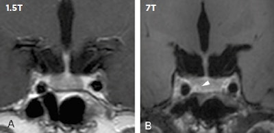 In clinical imaging, 7-tesla MRI can make a difference in detecting and ruling out pituitary lesions. Compared with low-field MRI, 7-tesla MRI in 16 patients resulted in three newly detected pituitary lesions (shown by the white arrow), which had direct implications for neurosurgical planning (see de Rotte, Groenewegen A, Rutgers DR et al, European Radiology, January 2016, Vol. 26:1, pp. 271-277). All images courtesy of Dr. Jeroen Hendrikse.