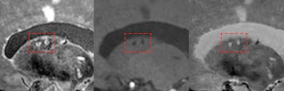7-tesla MRI can detect the total burden of larger and smaller infarcts, including small microinfarcts in the deep gray matter (shown here inside red frames).