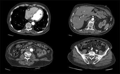 A 100-kV CT scan with a dose length product of 159.8 mGy.cm, using Canon's Advanced Intelligent Clear-IQ Engine (AiCE). Images are courtesy of Radboud UMC, Nijmegen, the Netherlands, and originally appeared in ECR Today on 1 March 2019.