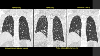 First image: Standard, high-dose CT at 12.4 mGy. Second image: Ultralowdose CT at 1.3 mGy. Third image: AI-enhanced ultralow-dose CT at 1.3 mGy. Diagnostic image quality between the first and third images was rated as comparable by independent radiologists, despite a significant dose reduction of 11.1 mGy. The second image is noisy and nondiagnostic. Image courtesy of Algomedica and Dr. Hugh Harvey, Kheiron Medical.