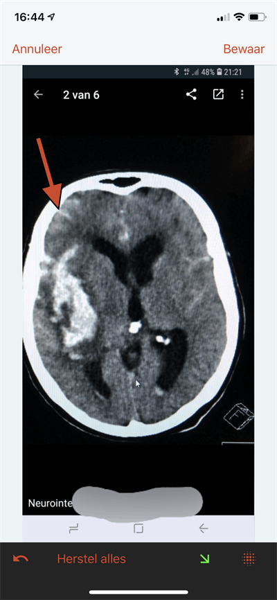 A screenshot of a brain CT with hemorrhage, using the Siilo app. It is possible to add arrows and manually erase some information (blurring on the bottom). Image courtesy of Dr. Erik Ranschaert, PhD.