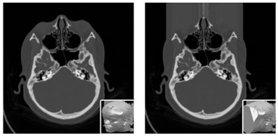 Sensitive features can be automatically detected and hidden by covering the face with a shapeless mask of pseudorandom noise. Image courtesy of N. Roduit, University Hospital of Geneva.