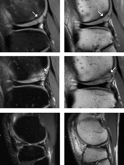 A 25-year-old male tennis player after microfracturing (MFX), or bone drilling. With MFX, small holes 3- to 4-mm apart from each other are drilled into the subchondral bone to stimulate the bone marrow (stem cells). MR images one year after MFX (top row) show persistent mild subchondral bone marrow edema and high T2 signal change of the cartilage (white arrows) at the posterior portion of the lateral femoral condyle. At two-year follow-up (middle row), there is progressive subchondral bone marrow edema, undermining fluid at the interface between the subchondral bone and the cartilage, and interstitial tears of the detached cartilage (white arrows). This is consistent with incomplete integration of the chondral defect. MR images four years after MFX (bottom row) surprisingly show complete integration of the chondral defect without any additional treatment. Images courtesy of Dr. Claudia Weidekamm.