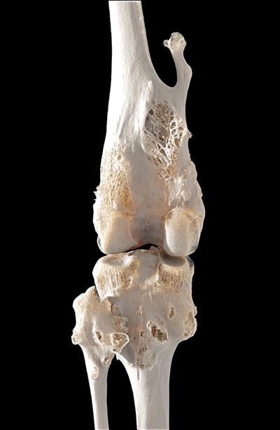 Aquilion Precision ultrahelical CT scan (0.25 mm x 160 detector rows) of the left knee, performed with FIRST. Global Illumination 3D volume rendering demonstrates exostoses. Image courtesy of Canon Medical Systems.