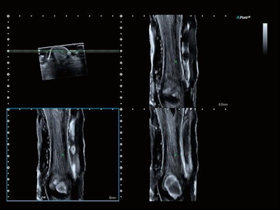 Image of Achilles tendon. Coronal view acquired on the Aplio i800 system with Smart 3D at 24 MHz. Image courtesy of Canon.