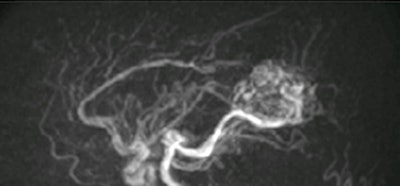 4D ASL angiography demonstrates the feeding arteries and nidus of a cerebral arteriovenous malformation. Image courtesy of Dr. Rolf Jäger.