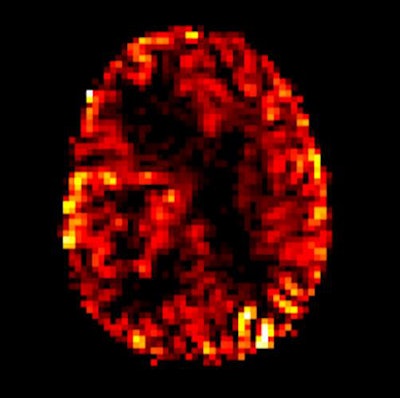 Arterial spin labeling perfusion imaging shows increasing blood flow in a malignant brain tumor in the right cerebral hemisphere. Image courtesy of Dr. Rolf Jäger.