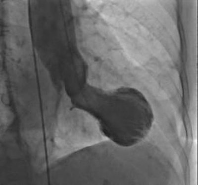 TTS is a sudden, temporary weakening of the heart muscles that causes the left ventricle of the heart to balloon at the bottom, while the neck remains narrow. The condition creates a shape that resembles a Japanese octopus trap, from which it gets its name. Image courtesy of Dr. Christian Templin, University Hospital Zurich.